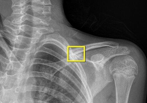 Une radio de fracture d'épaule