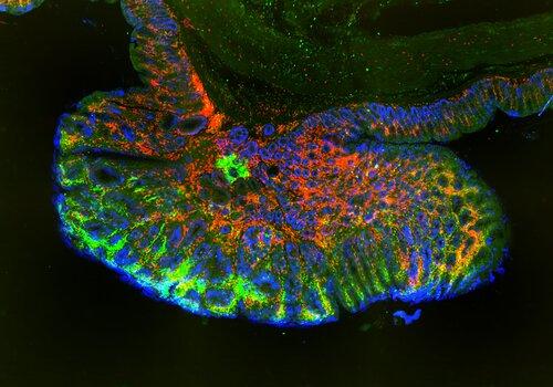 Coupe de tumeur avec marquage coloré fluorescent