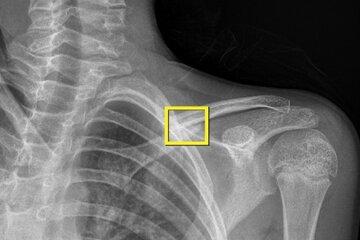 Une radio de fracture d'épaule