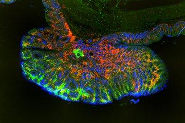 Coupe de tumeur avec marquage coloré fluorescent
